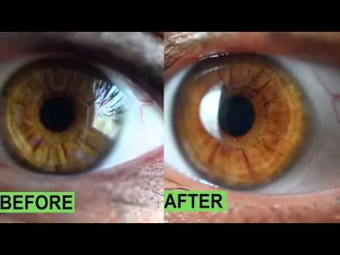 Diagnosi della malattia attraverso l'iridologia degli occhi prima e dopo quello che è successo all'iridologia di Osaka