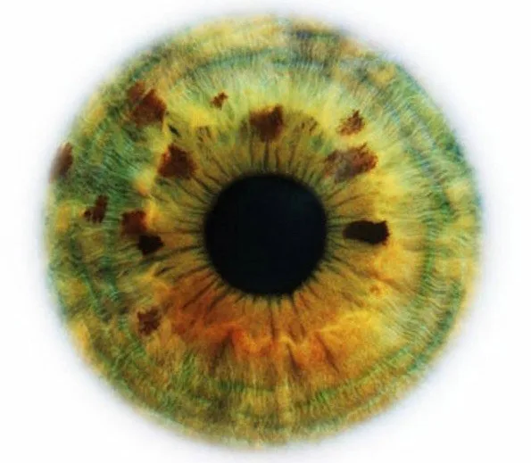 iridology online red ring around iris how to read eyes iridology