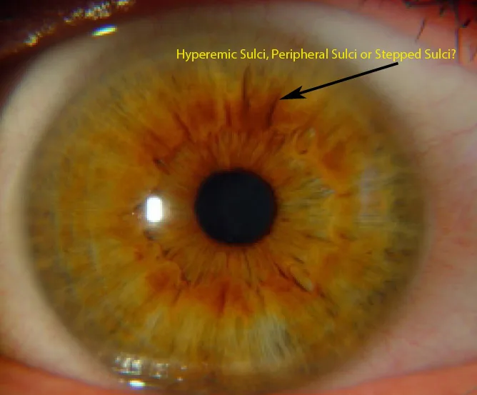 Cadi Iridology Camera