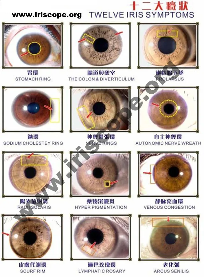 How to read iridology chart?