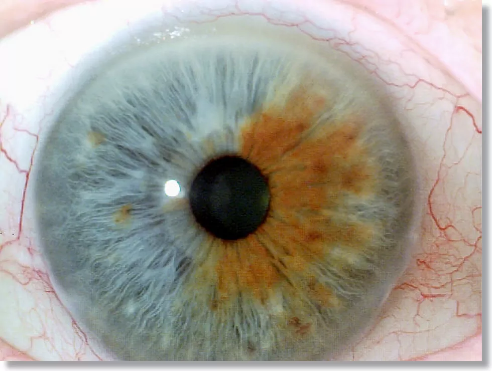 Cómo tomar una fotografía de tus ojos para iridología?