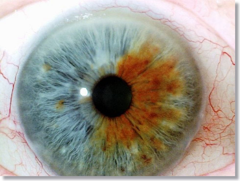 Significados de los colores de Iridología