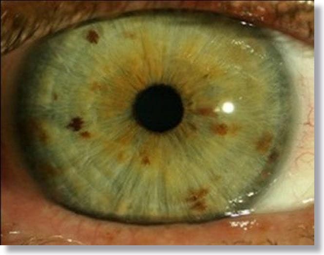 Significados de los colores de Iridología