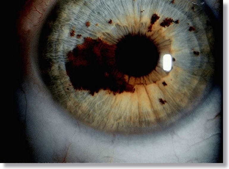 Significados de los colores de Iridología