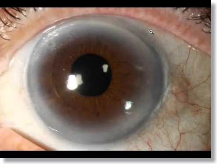 Tabela de cores dos olhos Iridology Marrom