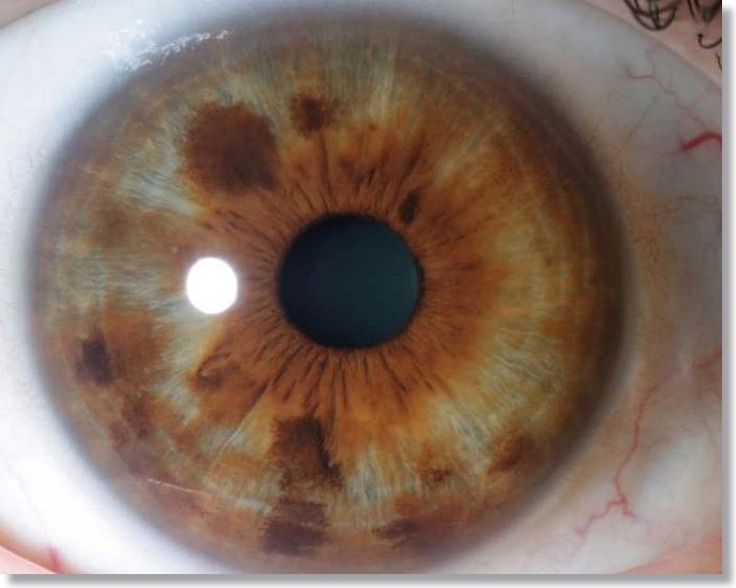Carta de colores de ojos de Iridología Marrón