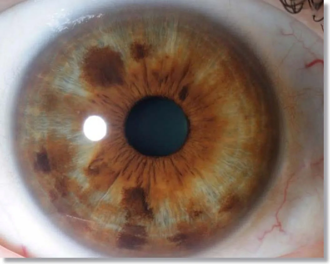 Tabela de cores dos olhos Iridology Marrom