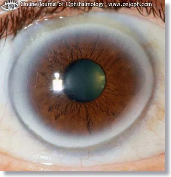 Carta de colores de ojos de Iridología Marrón
