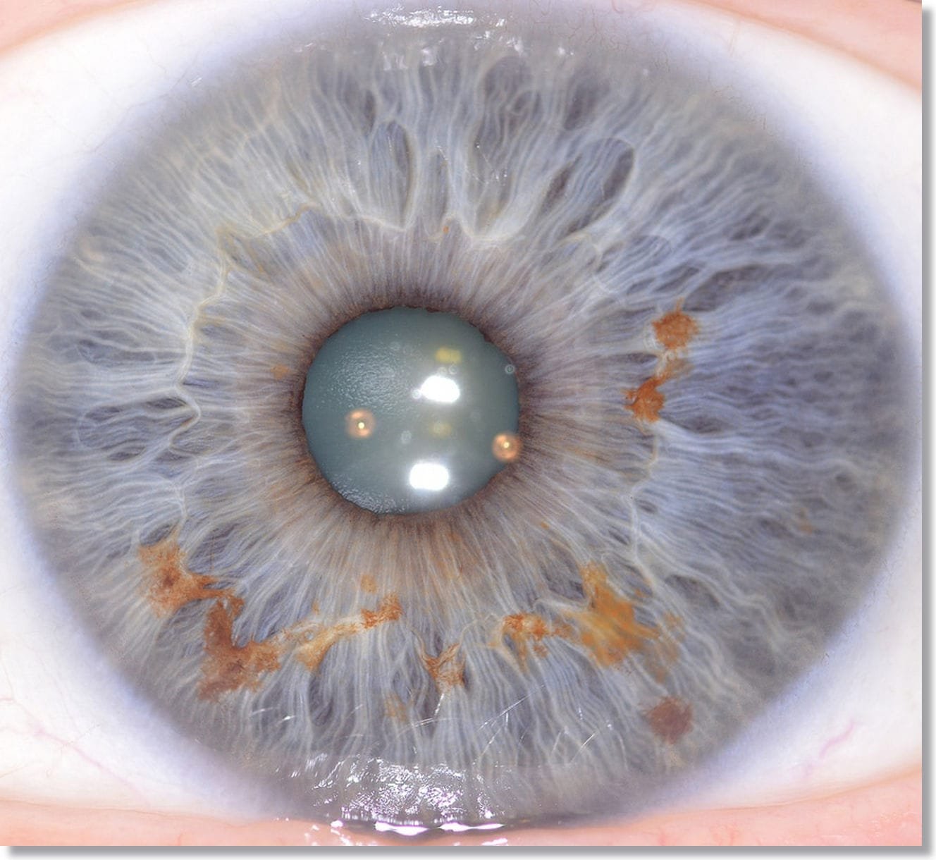 YouTube: Cómo tomar una fotografía clara para iridología?