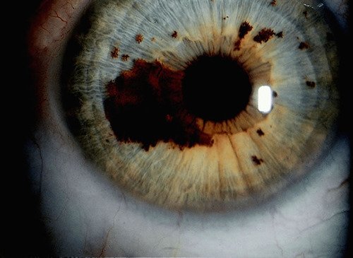 Close-up capture of human iris stroma using optical magnification equipment