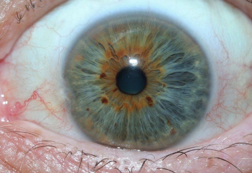 Allergy Reflected in Eyes Iridology