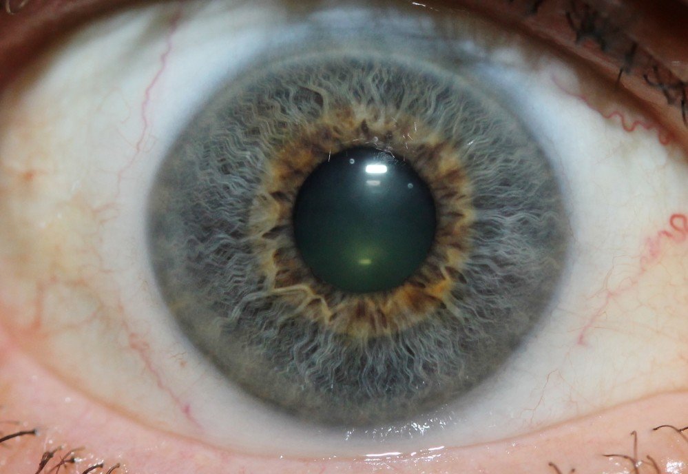 Allergy Reflected in Eyes Iridology