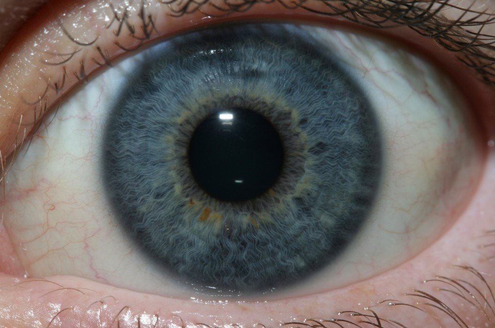 Allergy Reflected in Eyes Iridology