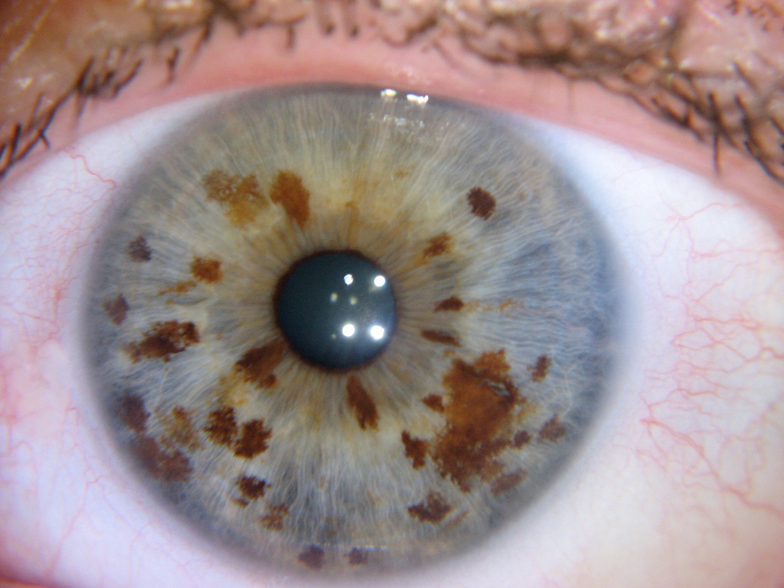 MAIKONG iriscope iridology camera 12MP 9822 For Win 7/8/10/11 And Apple Mac OS MK9822U — nerve rings iridology Examples.jpg
