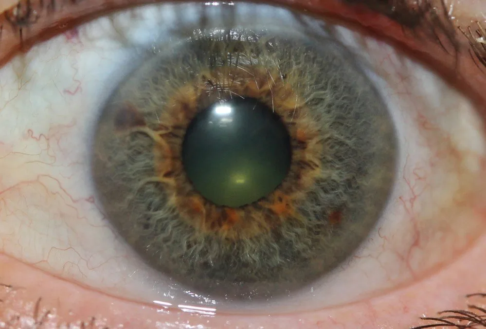 Which companies supply iridology cameras to South Africa — practical answer for Holistic Practitioners — iridology images 32.jpg