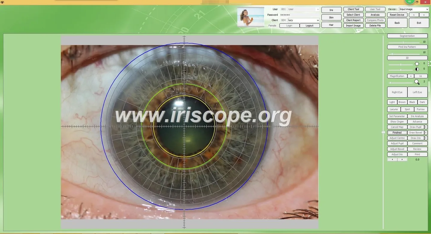 Which iridology software should a Herbalist in South Africa consider — practical choices and why — Software de Iridología (34).JPG