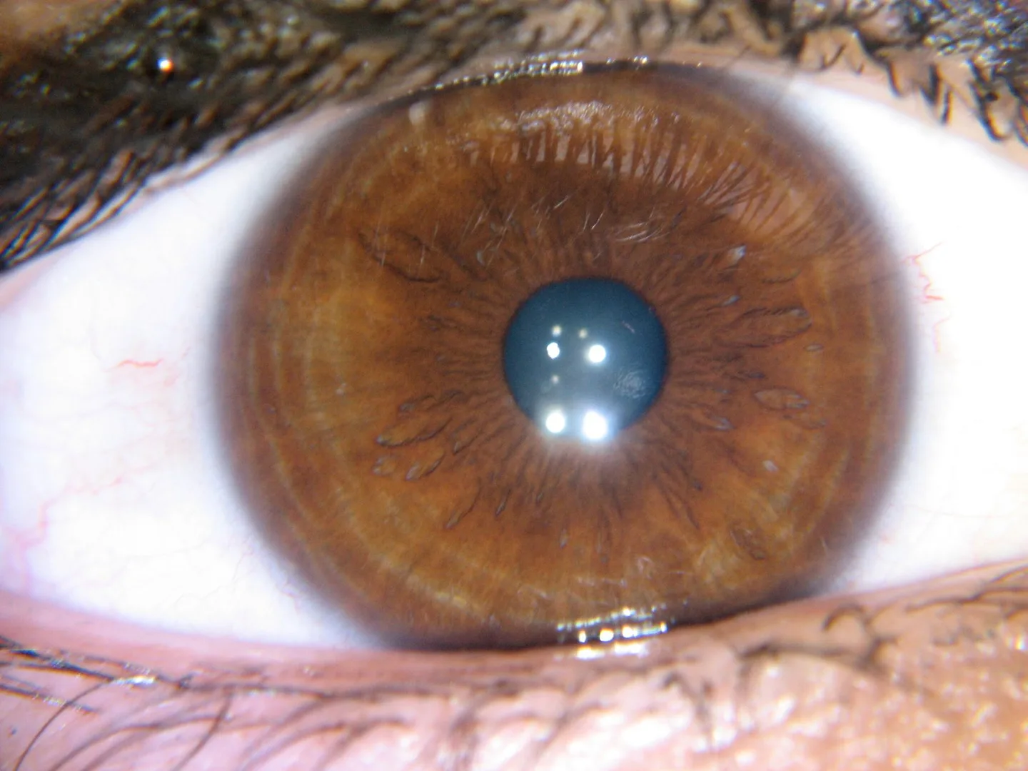 Which iridology software should a Herbalist in South Africa consider — practical choices and why — iridology yellow ring around pupil 6.jpg