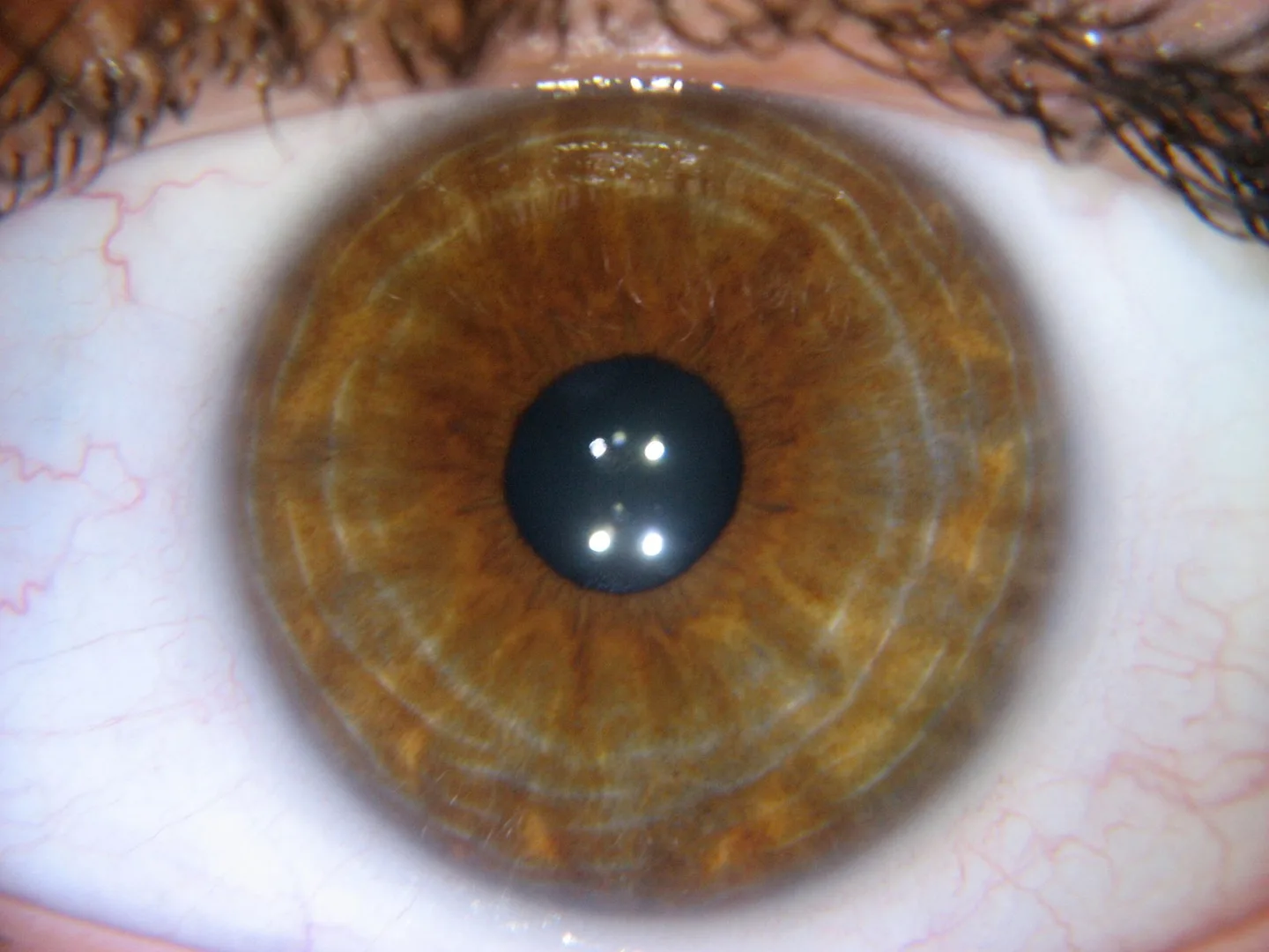 Which iridology software should a Herbalist in South Africa consider — practical choices and why — iridology yellow ring around pupil 5.jpg